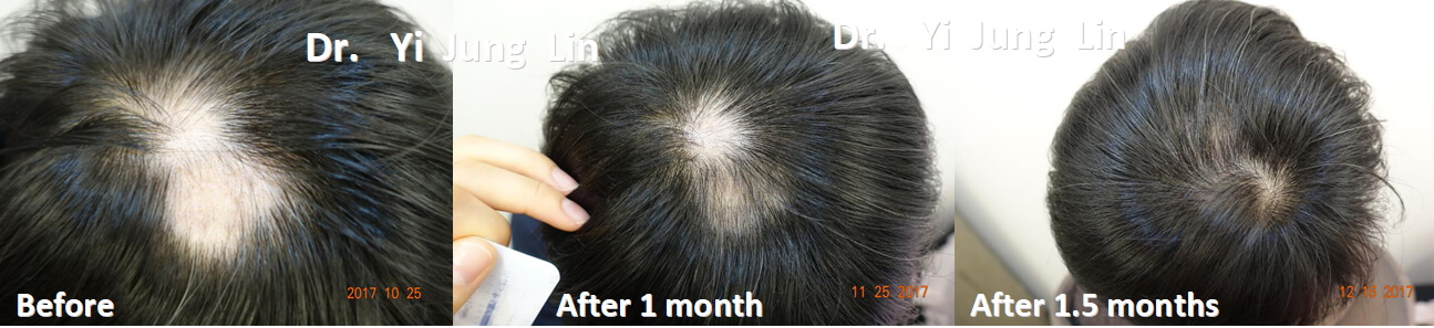 落髮治療成功案例3